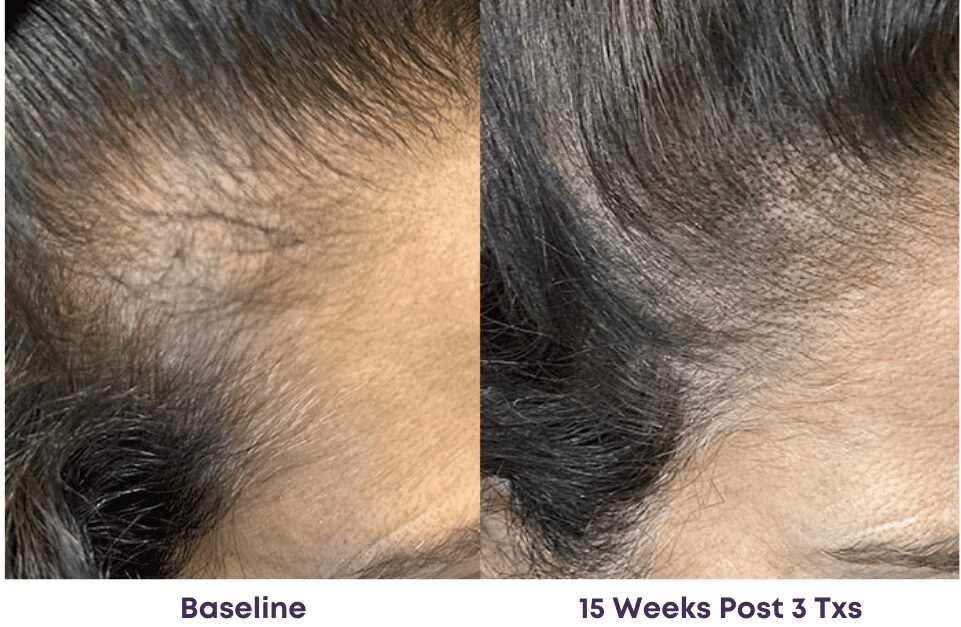 Alma TED Hair Rejuvenation – Painless, needle-free hair restoration with no post-treatment shedding