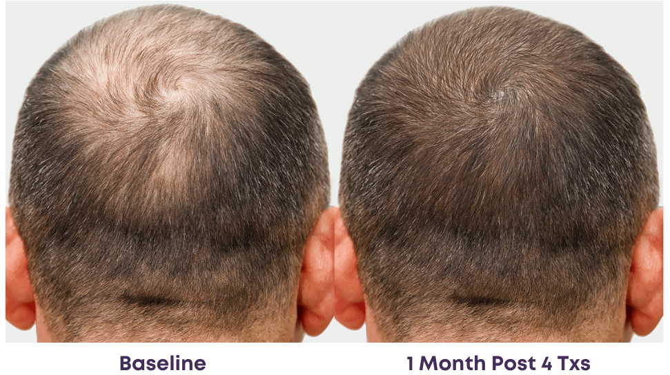 Alma TED Hair Rejuvenation – Painless, needle-free hair restoration with no post-treatment shedding