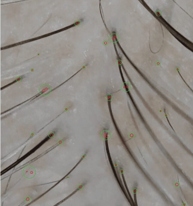 Encourages Natural Hair Regrowth: Strengthens hair follicles and promotes natural regrowth. Improves Hair Thickness and Volume: Enhances follicle health for fuller, thicker hair.