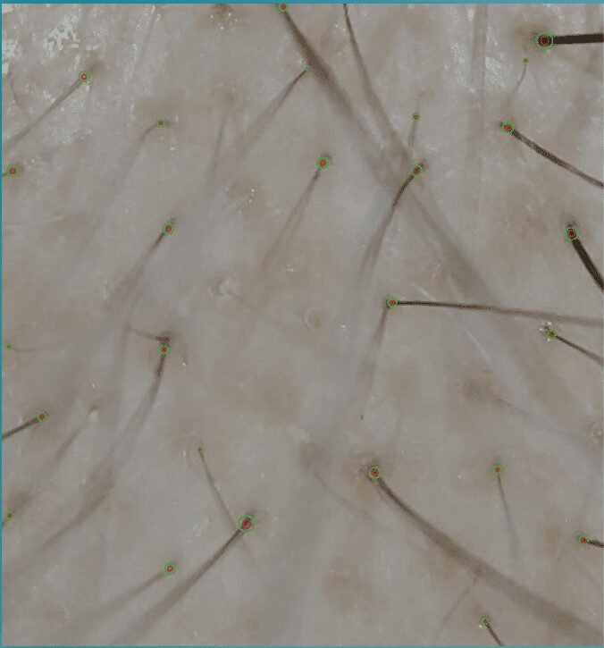 Alma TED Hair Rejuvenation – Painless, needle-free hair restoration with no post-treatment shedding